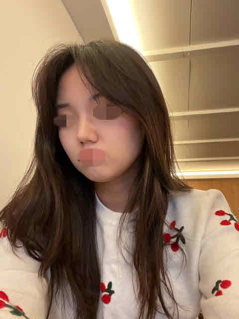 수술 받은 지 4개월 지났는데 무난하게 회복하고 있고 너무 만족스러워요!!