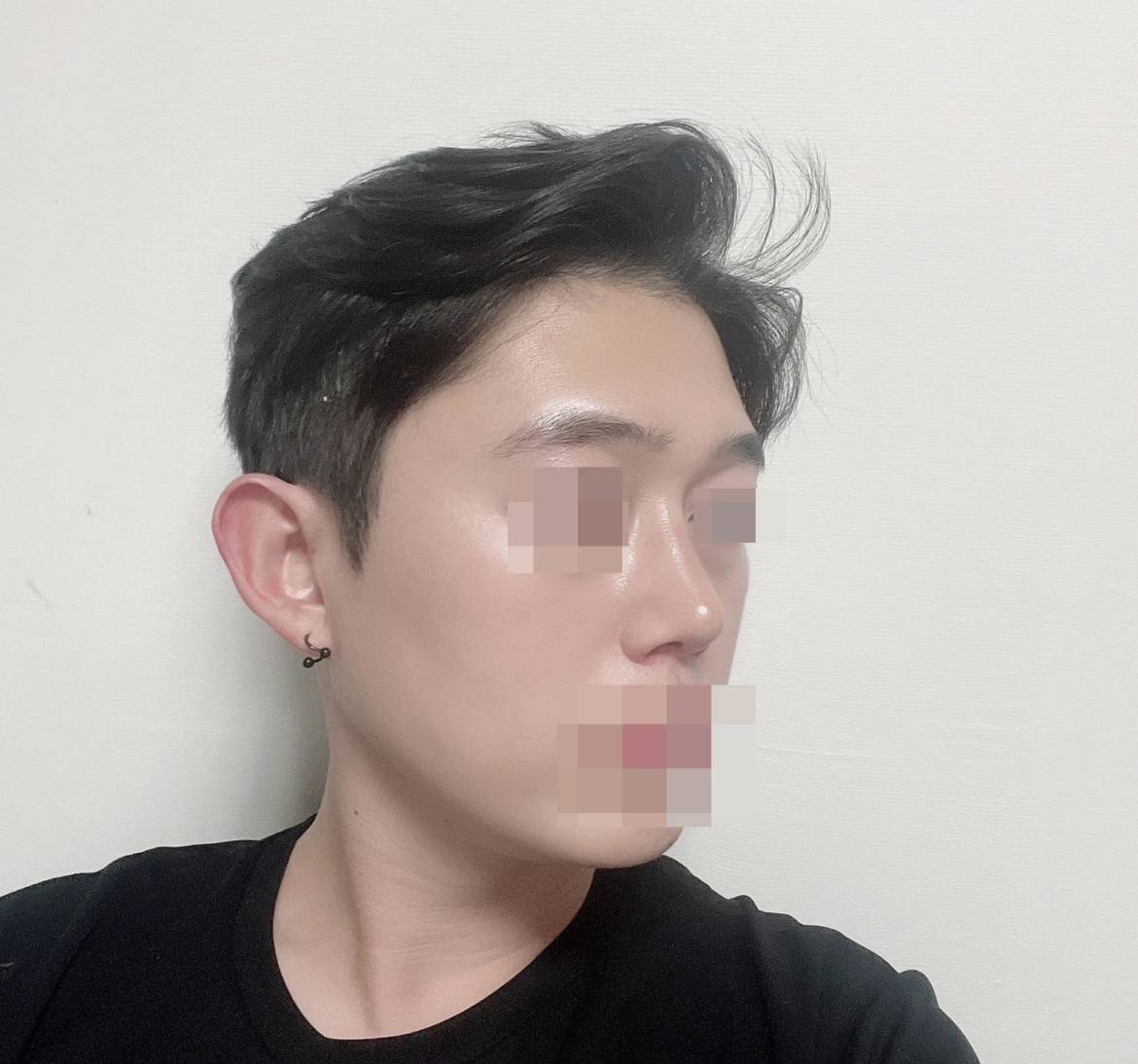 수술 후 사람다운 코가 됬습니다 매우 만족합니다