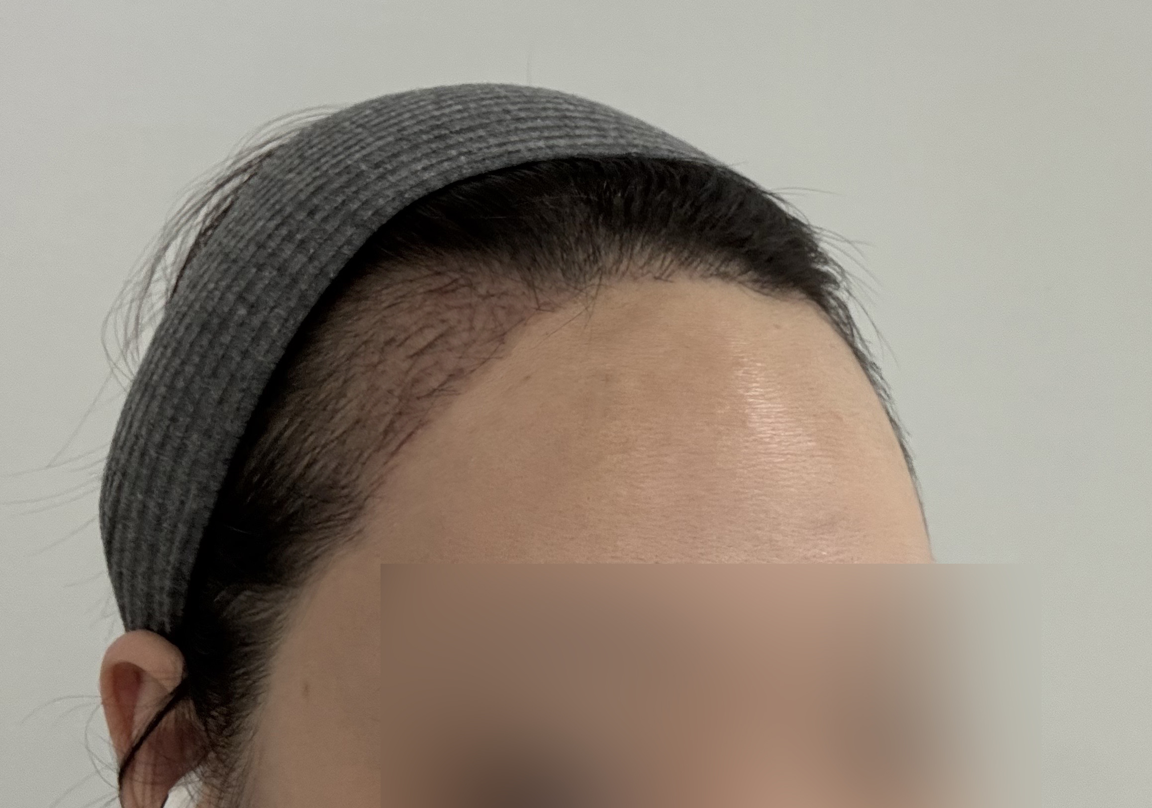 절개 모발이식 1달차, 암흑기에도 기대중인 변화
