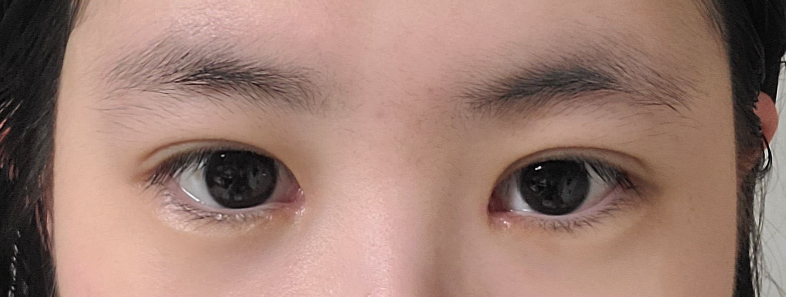 눈 수술 1달 경과 후기 – 큰 붓기 빠지고 자연스러워짐