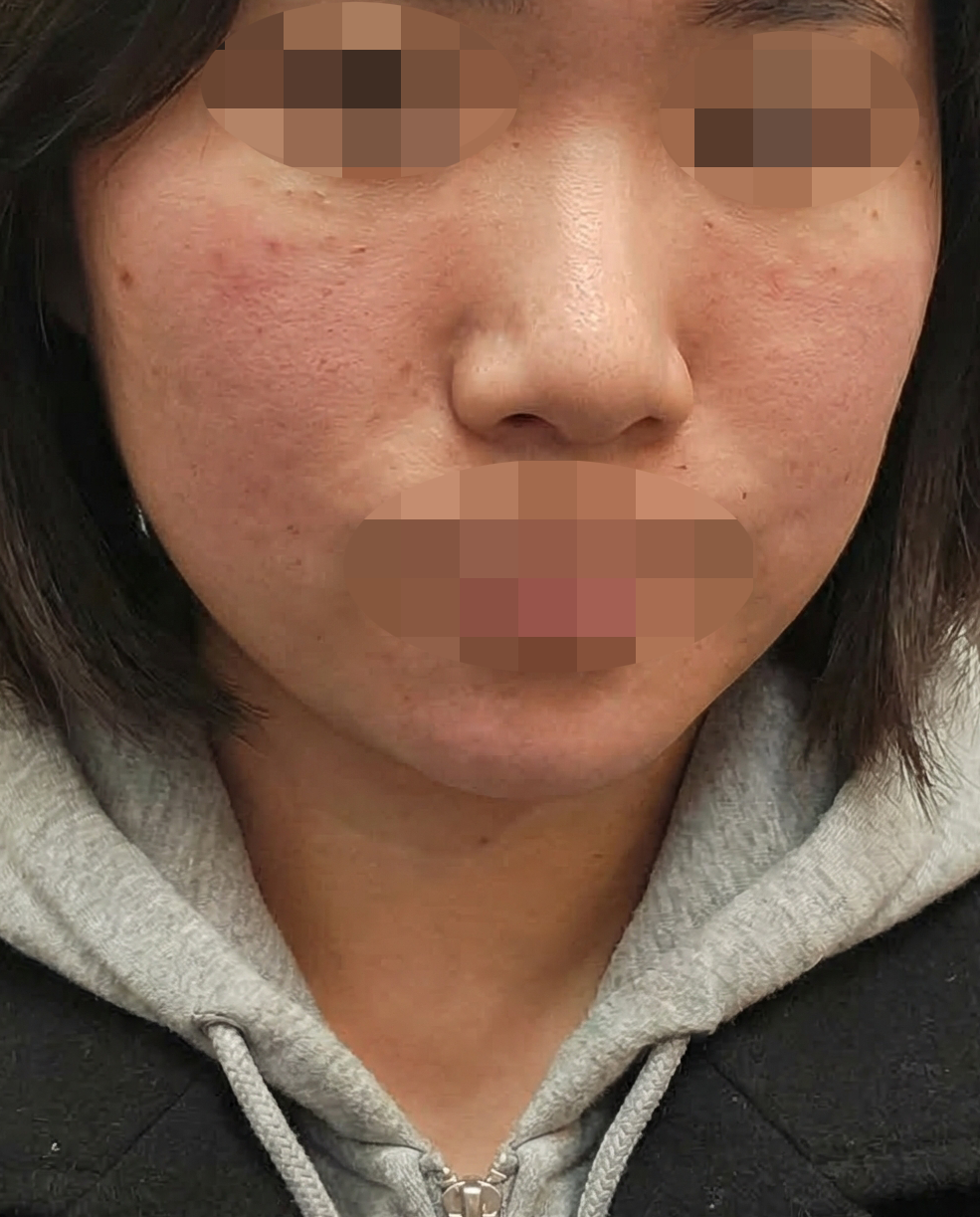 리쥬란이랑 써마지 같이 받았는데 수면이라 편한 것 같아요 ㅎㅎ