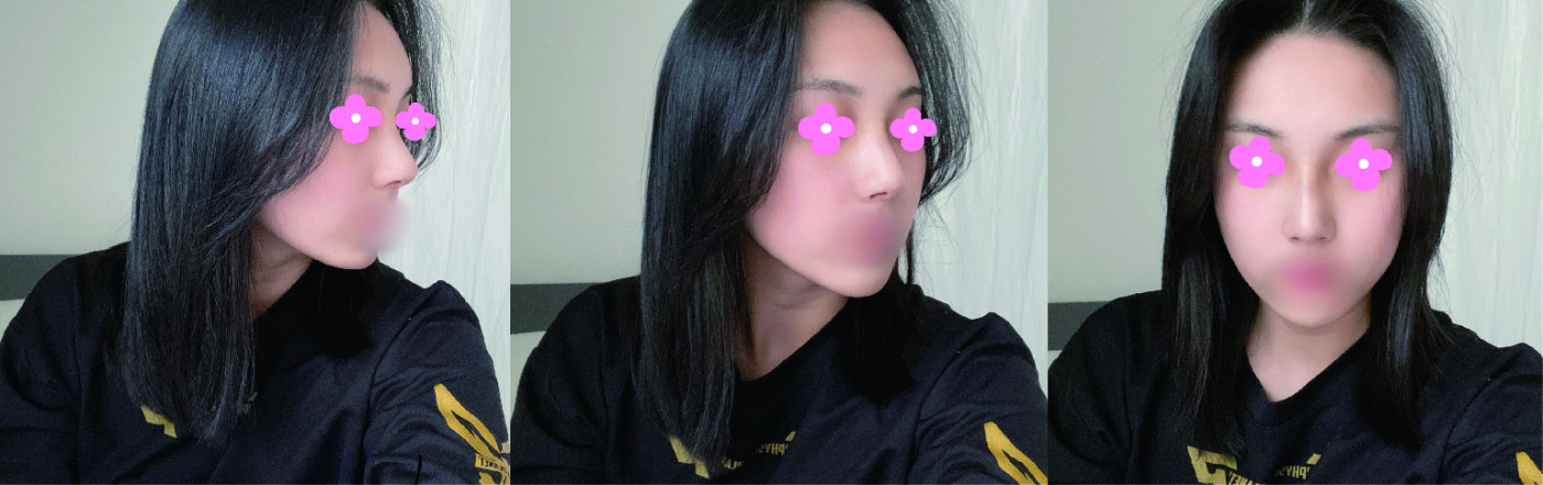 서울아이에서 코수술한 후기