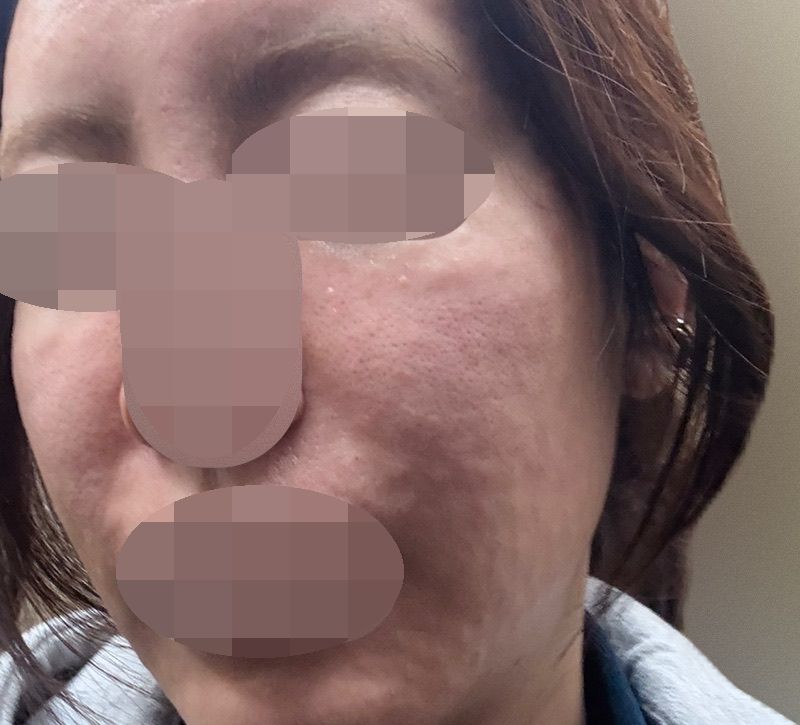 마취 전문의 있어서 믿고 받았네요ㅎㅎ 환절기라 푸석해서 받았는데 만족인 것 같아요!