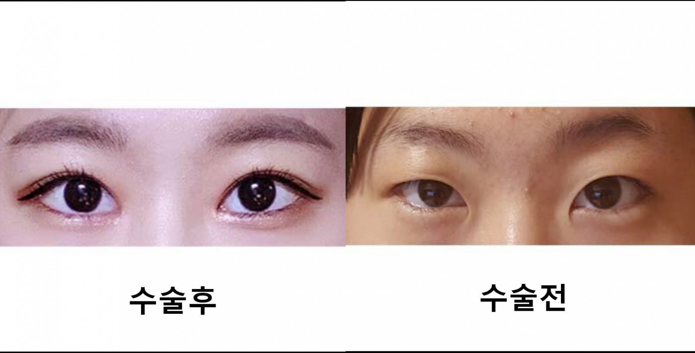 눈매교정, 쌍꺼풀, 윗트임!