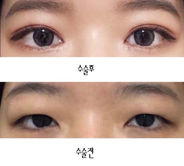 자연유착 앞뒤트임 눈매교정 수술후기
