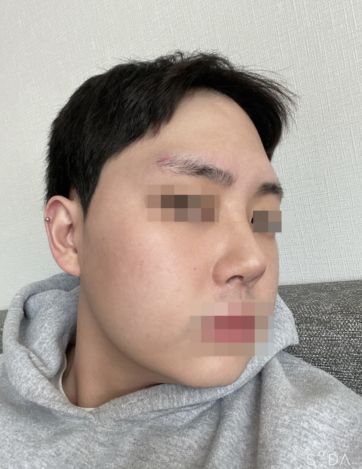 첫 코 성형 후기