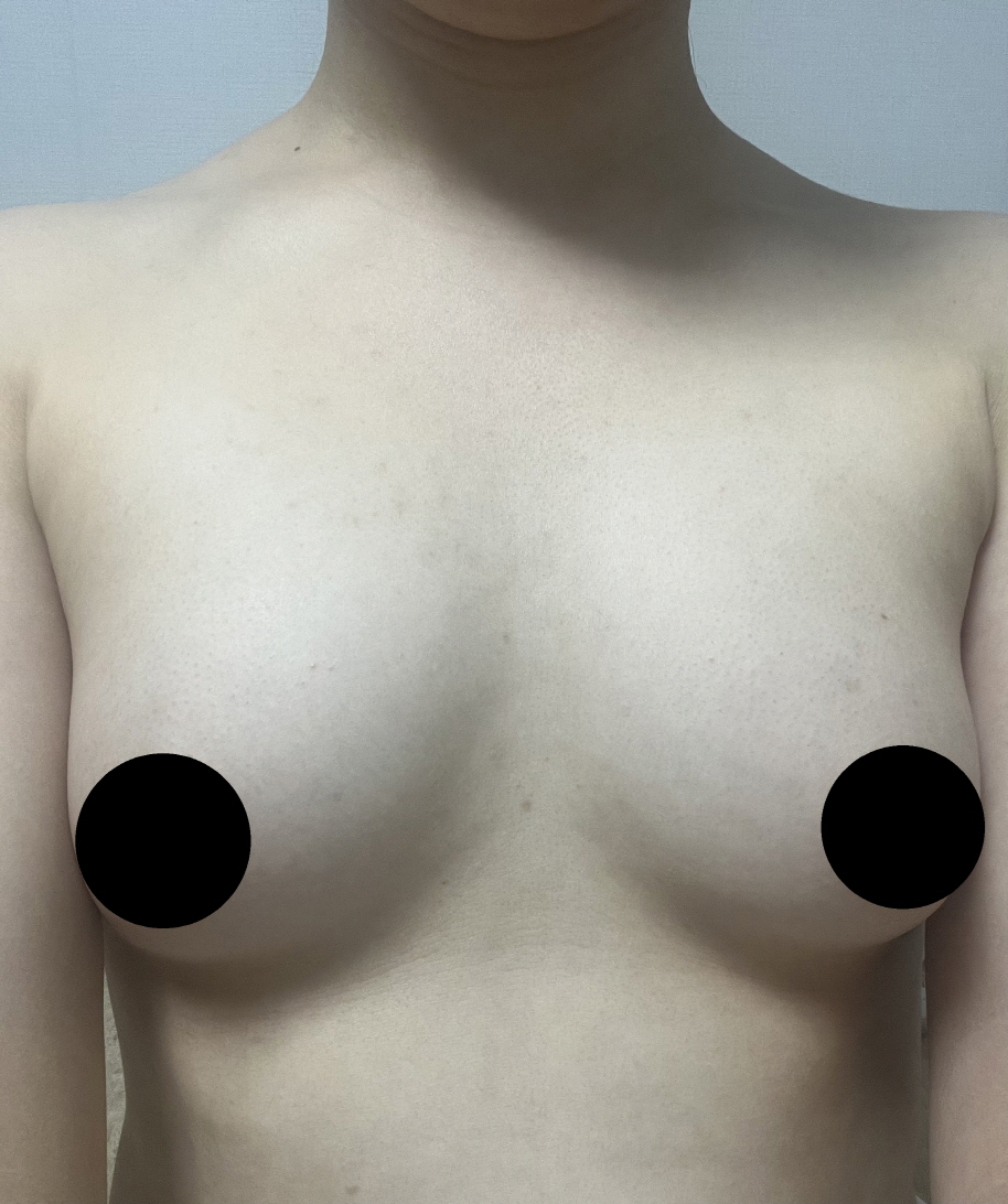 자연스럽게 잘 남아있습니다 ㅎㅎ 흉터관리는 아직 조금 더 해봐야 할 것 같아요!