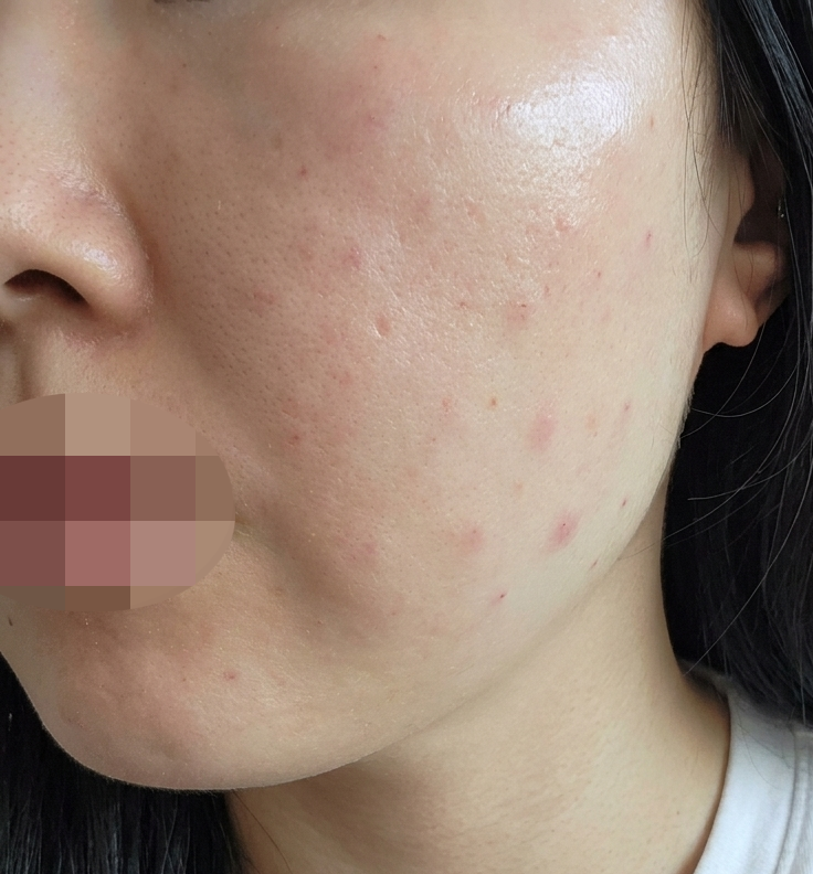 아무리 발라도 흡수 안 되는 피부, PRP로 속부터 채워봤어요~
