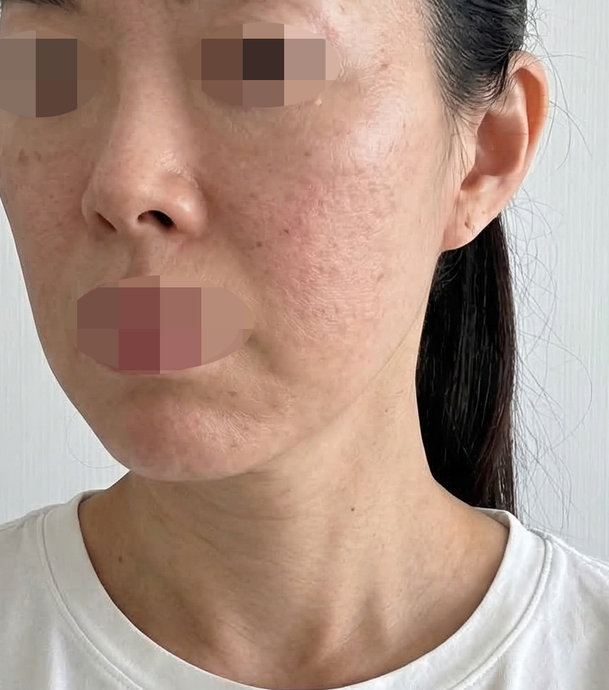 리쥬란이랑 스킨보톡스 같이 받았는데 효과 기대돼요~