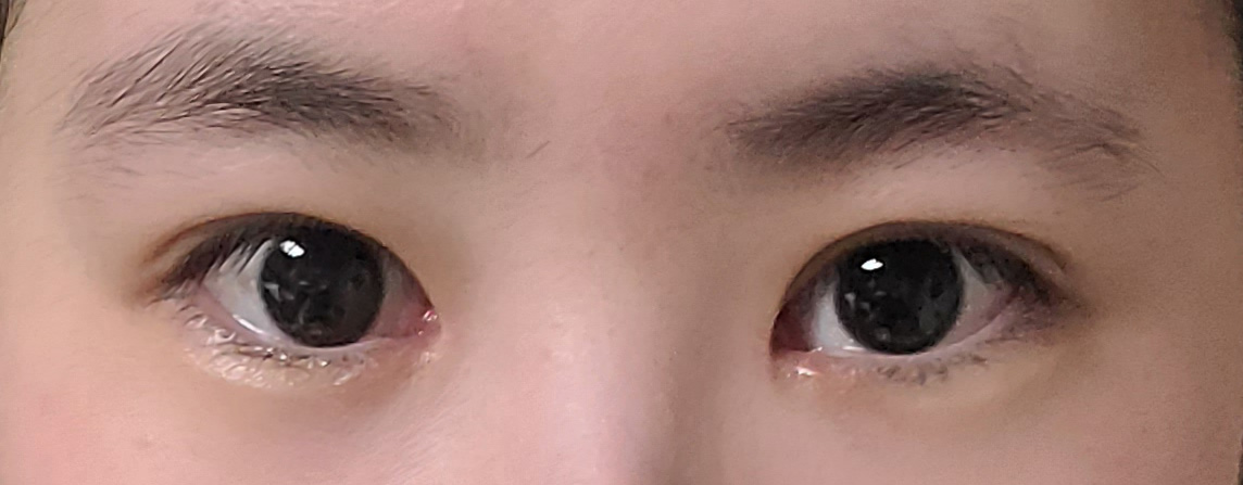 쌍수 붓기 빠지고 앞트임 흉터까지 깔끔,하게 없어졌어요!!
