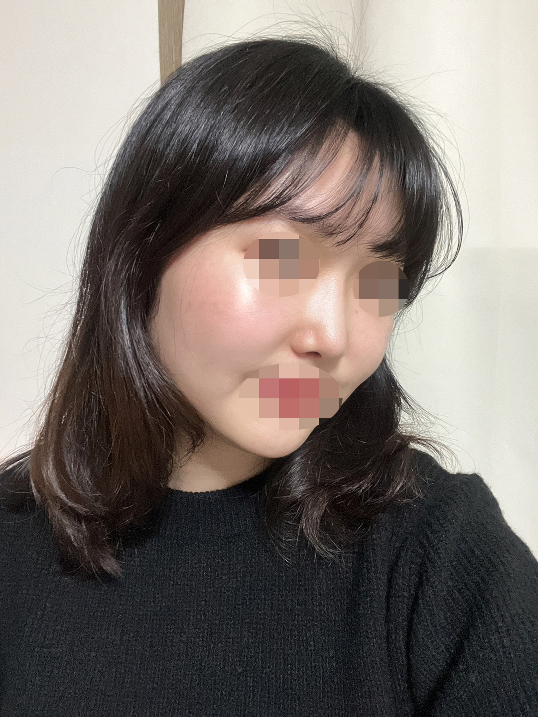 지금은 2달째이고 붓기도 거의 완벽하게 빠졌습니다!