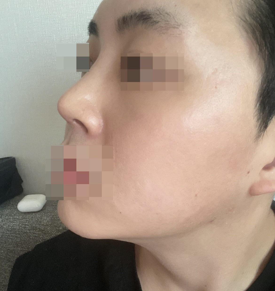 황원장님께 코 수술 1개월 차 후기