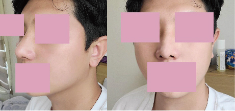 코수술후기입니다