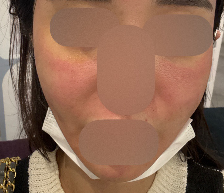 나이 들수록 필요한 리쥬란, 주기적으로 받으니 더 좋아요ㅎㅎ