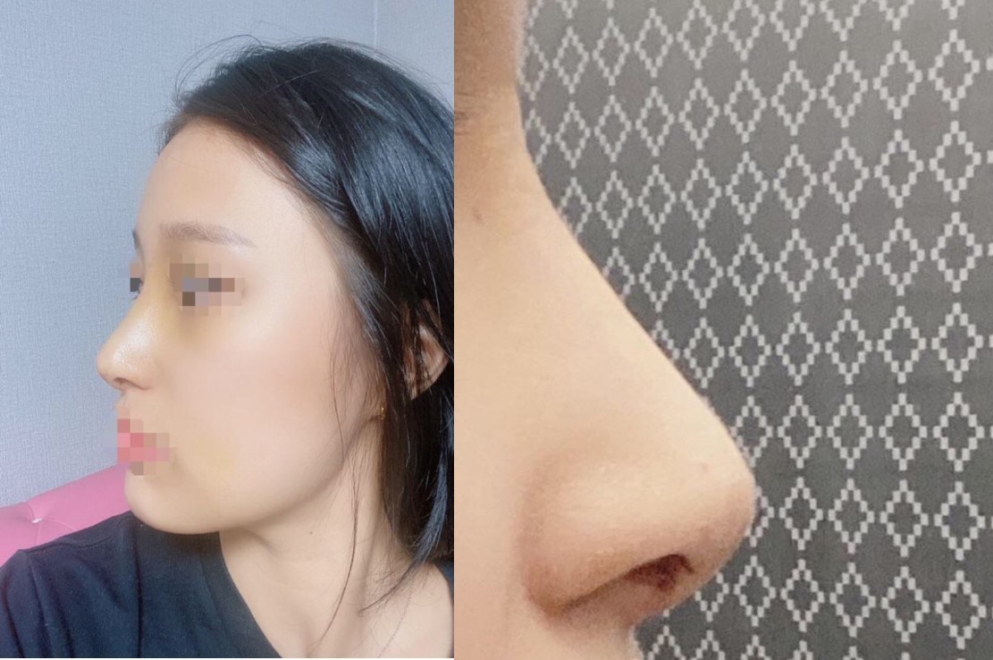 매부리코 수술 후기