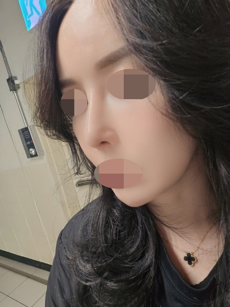 자연스럽게 높고 코끝모양이 너무이쁘게잘됐어요