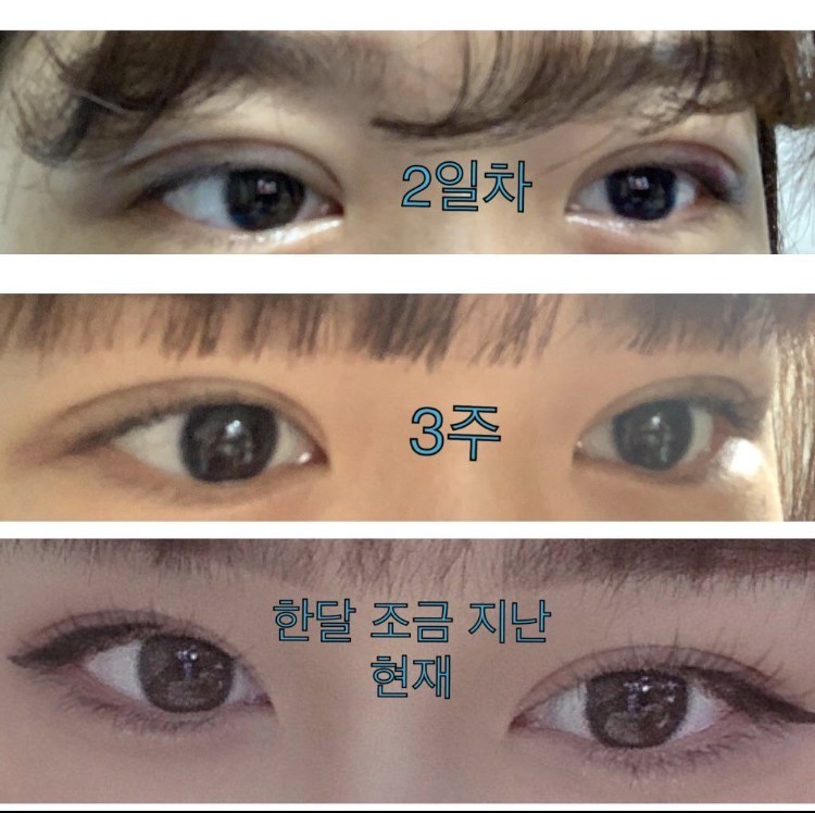 눈매교정 쌍수 1달 넘었어영
