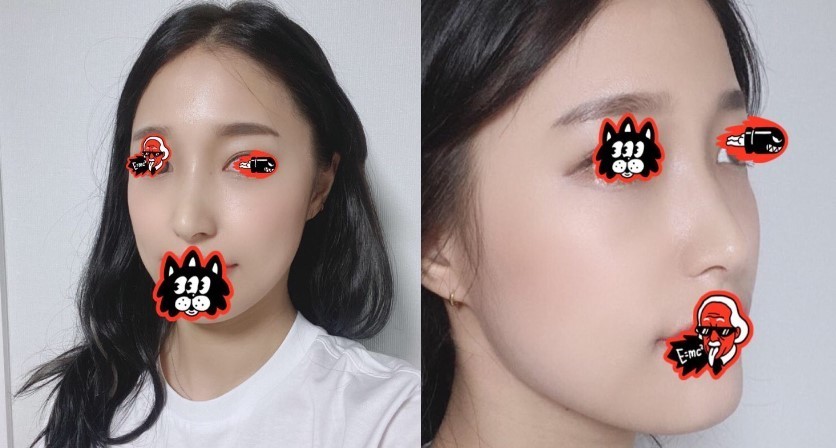 코수술 3주차