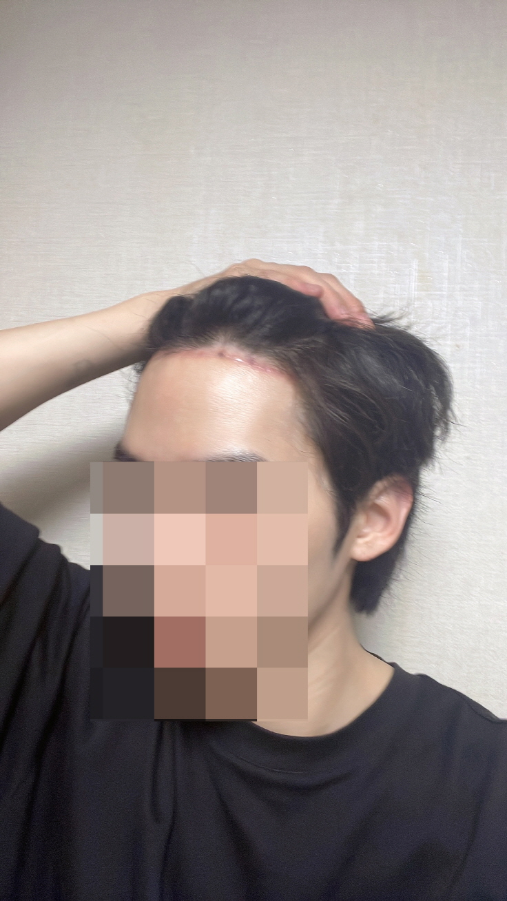 편안한 분위기 속에서 콤플렉스였던 이마 길이 줄였어요