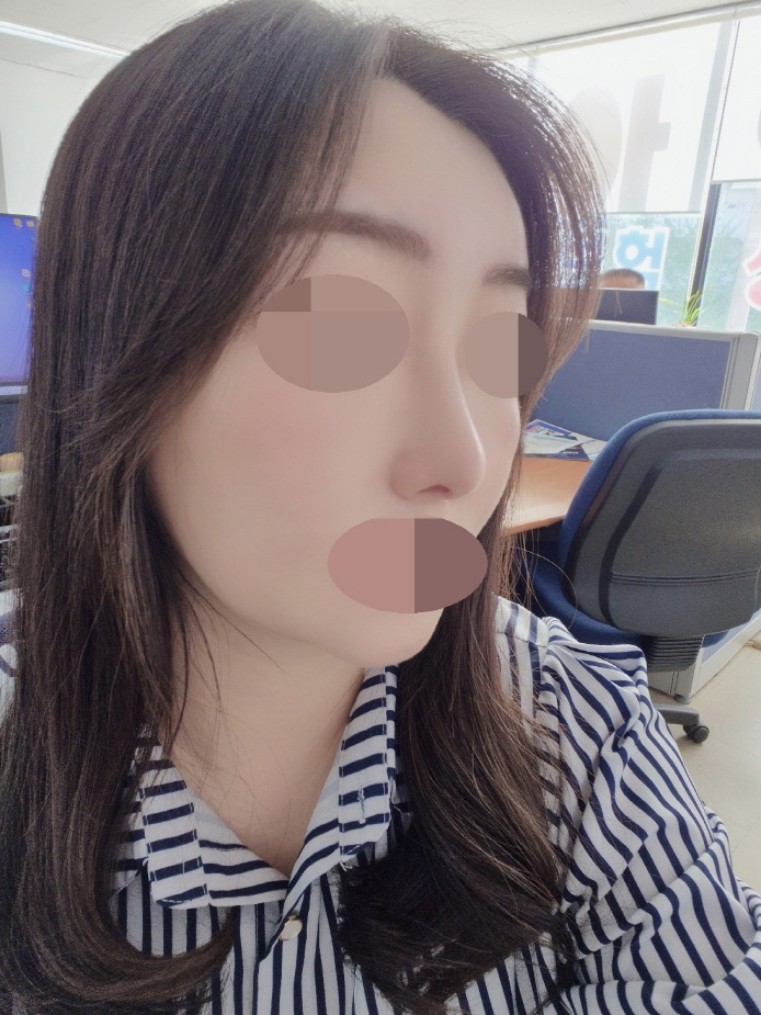 통증도 크게 없이 너무 예뻐져서 대만족 입니다