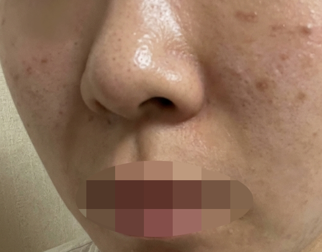 리쥬란 4cc 수면마취로 편하게 받았는데 결과까지 만족스러워요~