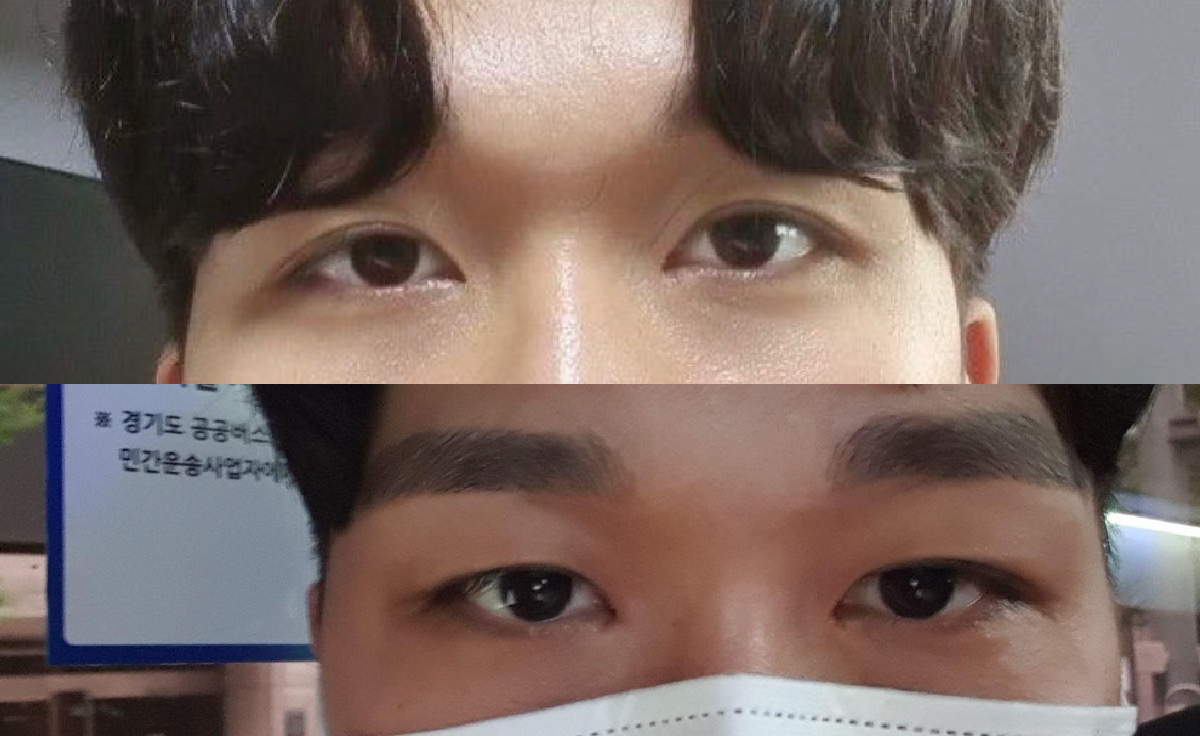 눈수술 3개월차 후기입니다!