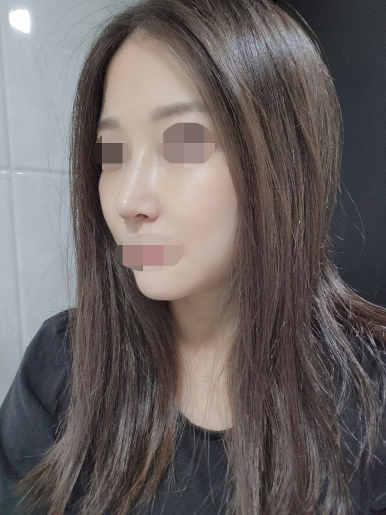 주변에서 물어보면 코수술은 황원장님 적극 추천할거에요~