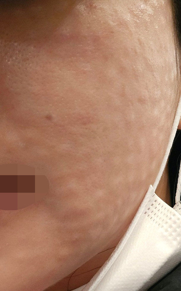 주기적으로 오는데 촘촘하게 해주셔서 엠보도 금방 사라져요 ㅎㅎ