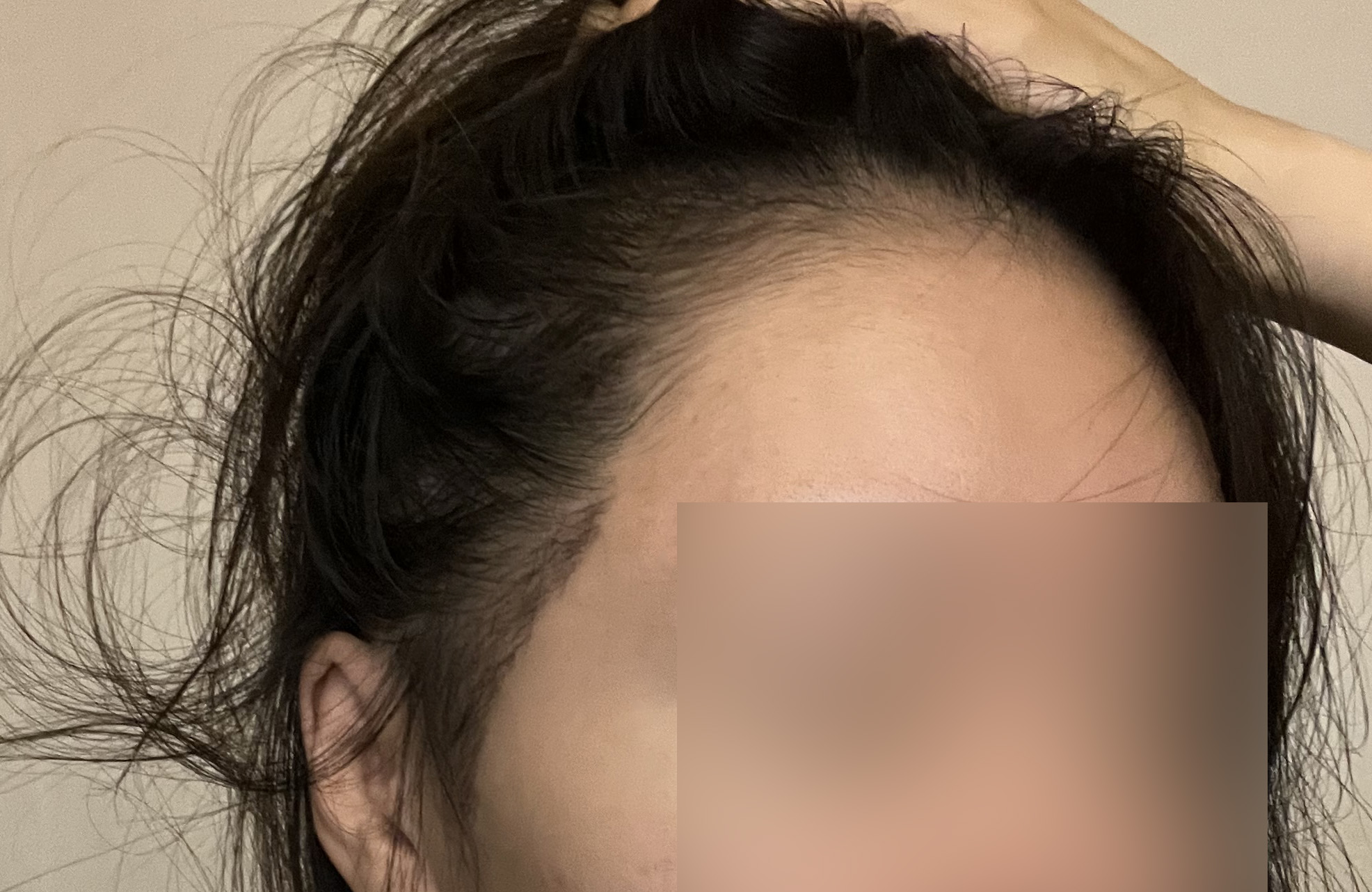 비절개 비삭발 구렛나루 2주차, 더 자라면 더 기대돼요