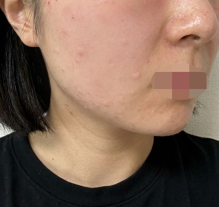 아프다는 후기 걱정했지만 수면 덕분에 부담 없었어요~