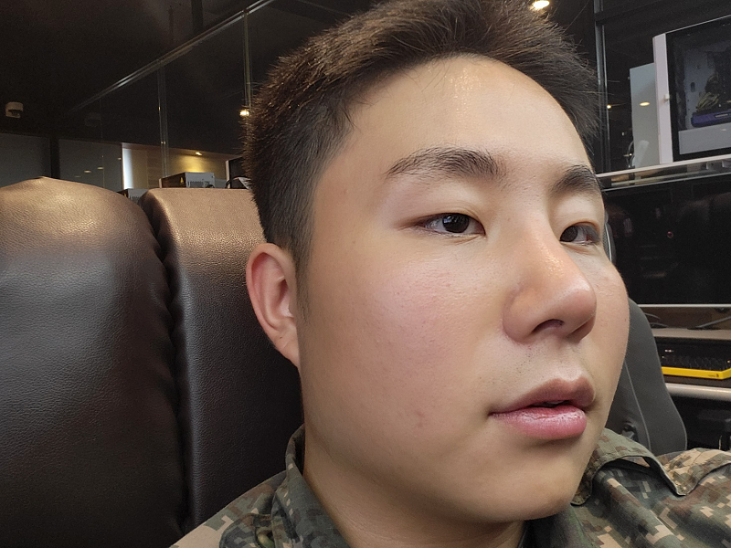 수술 2주차 사진입니다- 코 골절로 인하여 코 수술을 진행했어요