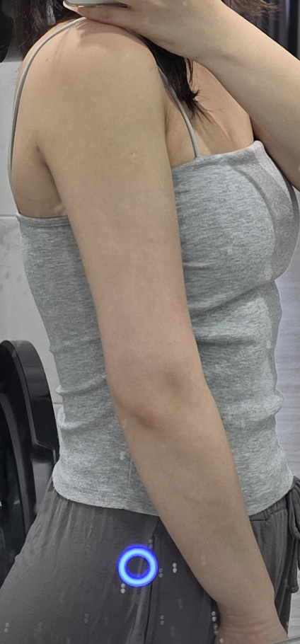 팔뚝 라인이 달라진 게 눈에 보여요! 팔뚝지흡 2달차 후기