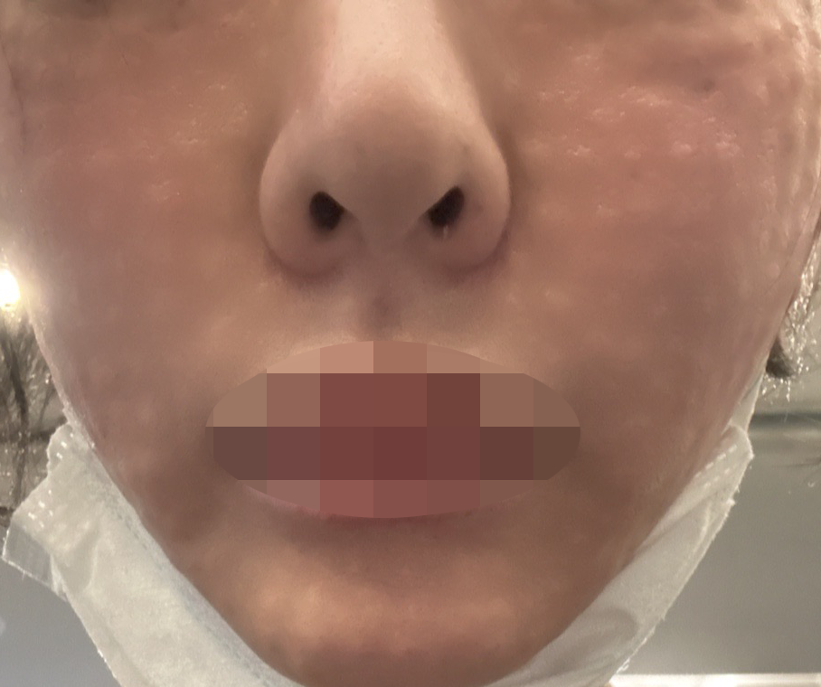 리쥬란 한 번 받고 만족해서 3회 결제하고 지인한테도 소개했어요 ㅎㅎ