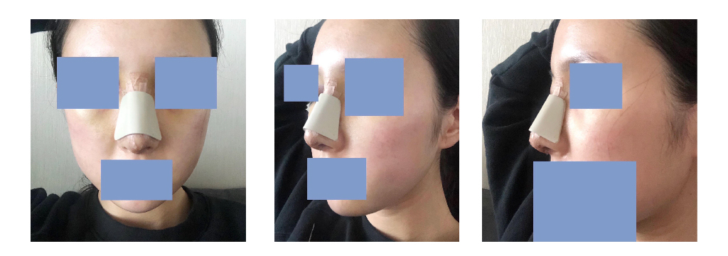서울아이 코끝, 휜코, 매부리코 수술 후기