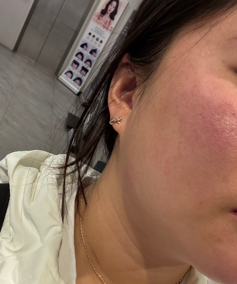 모공 스트레스였는데 스킨보톡스랑 슈링크 수면으로 받아서 통증 없이 좋았어요 ㅎㅎ