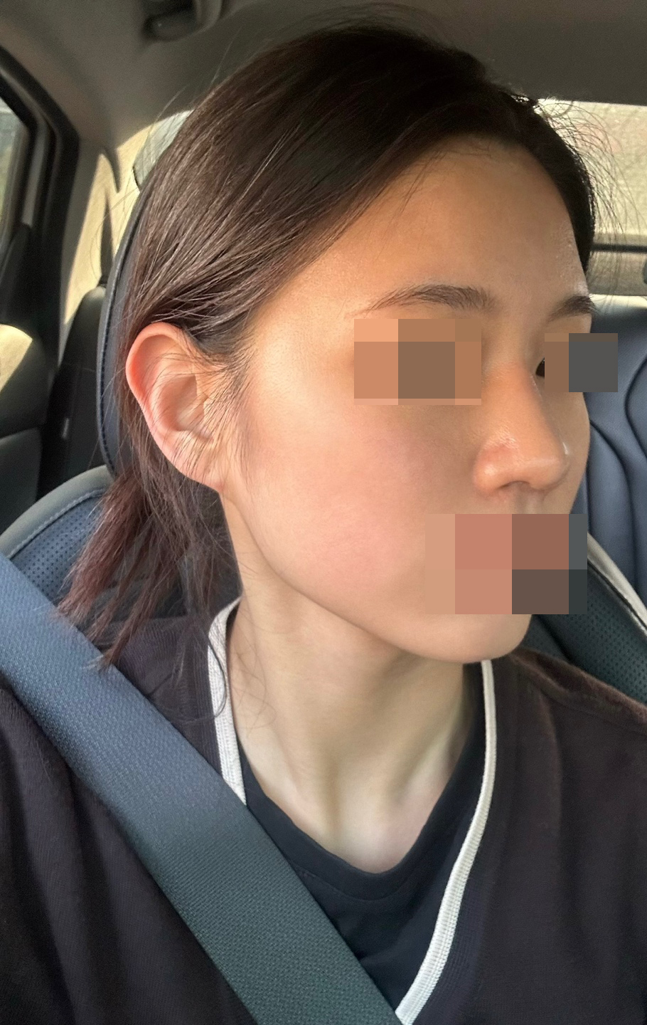 콤플렉스인 매부리랑 복코가 많이 보완돼서 굉장이 좋아요 ㅎㅎ
