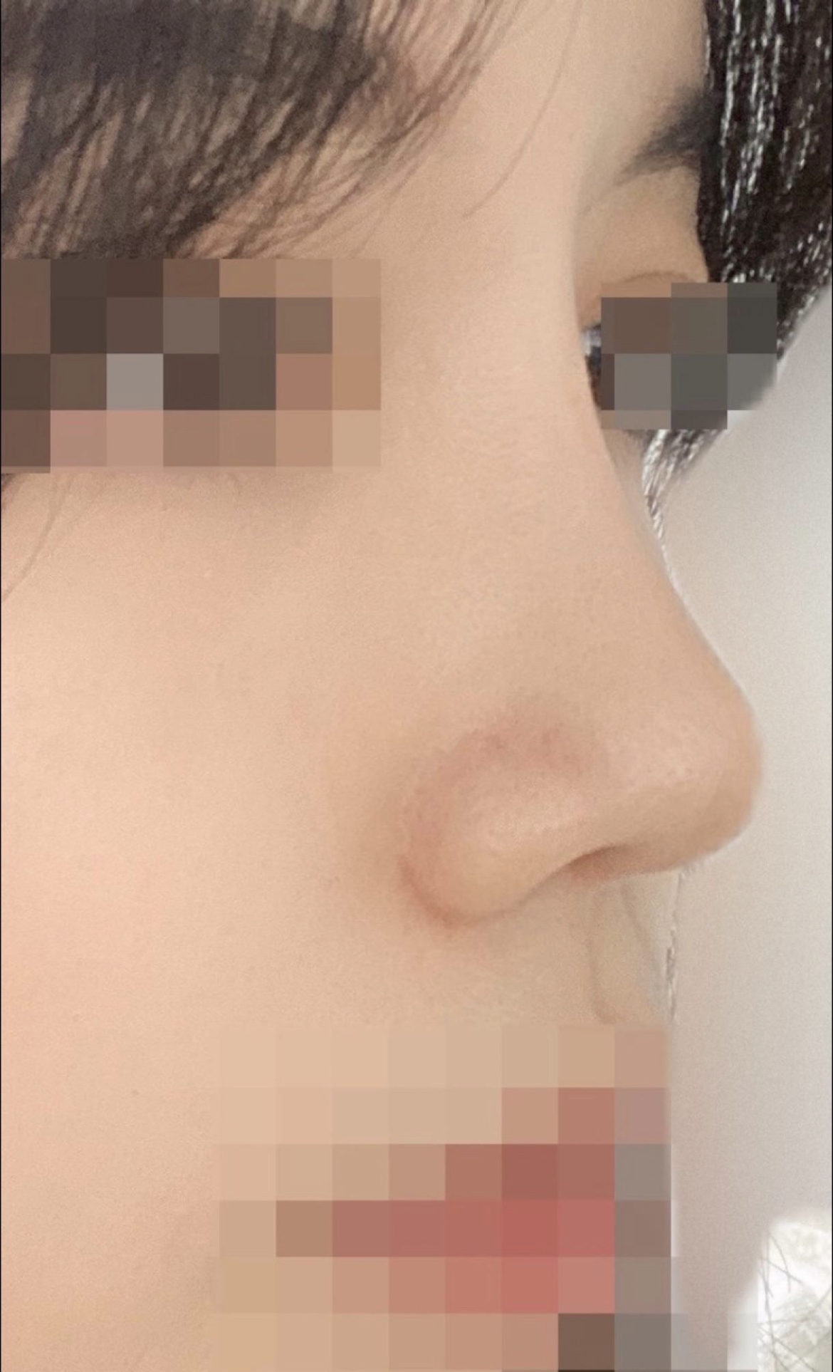코 성형 수술 한 달차 입니다!