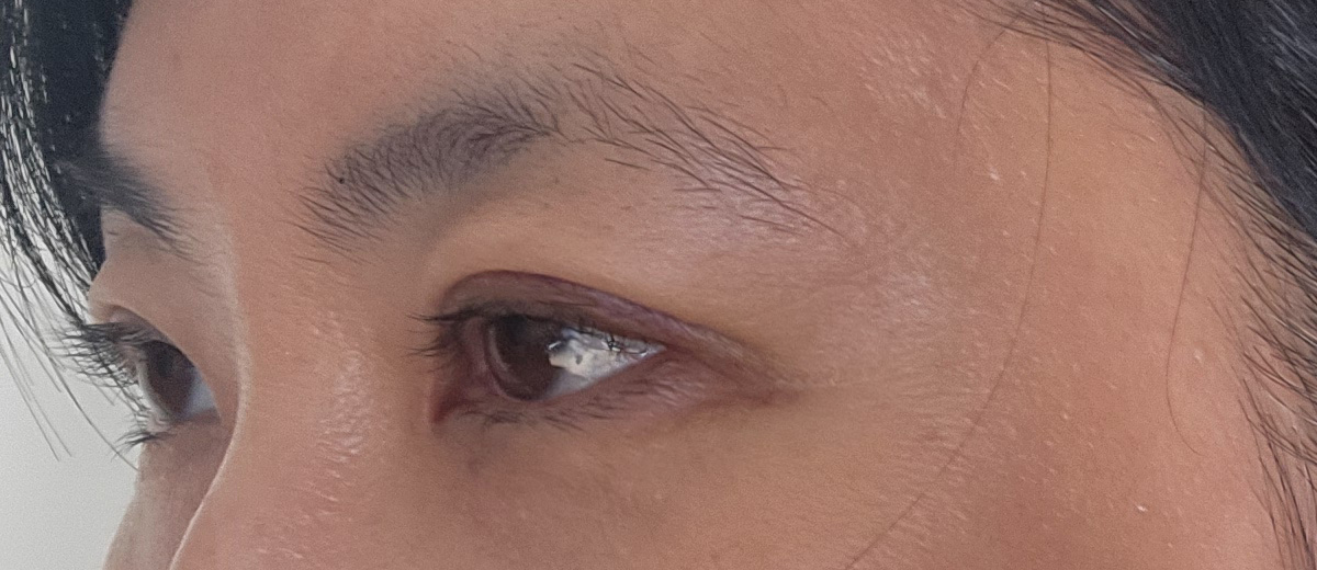 눈성형 2주차, 자연스럽게 자리잡은 쌍꺼풀 라인