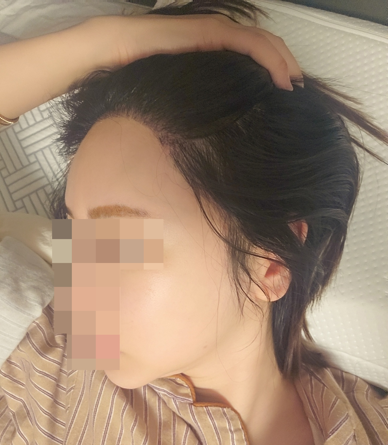 비절개로 했는데 만족합니당
