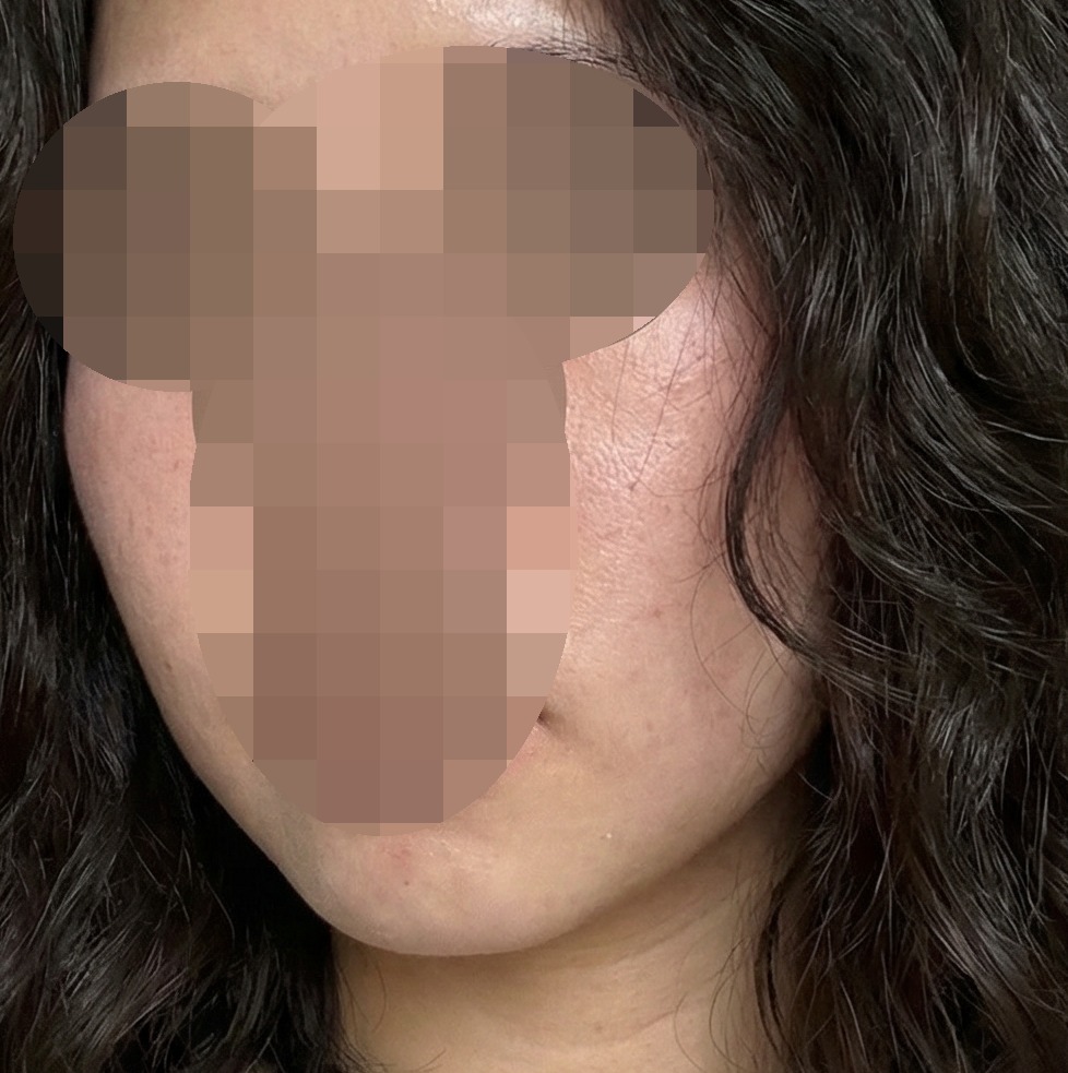 수면 리쥬란 받았는데 케어까지 해줘서 좋았습니다~