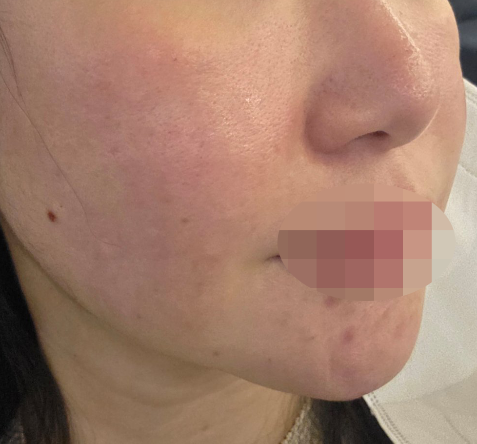 속건조 예방 차원으로 리쥬란 수면으로 편하게 받아봤어요