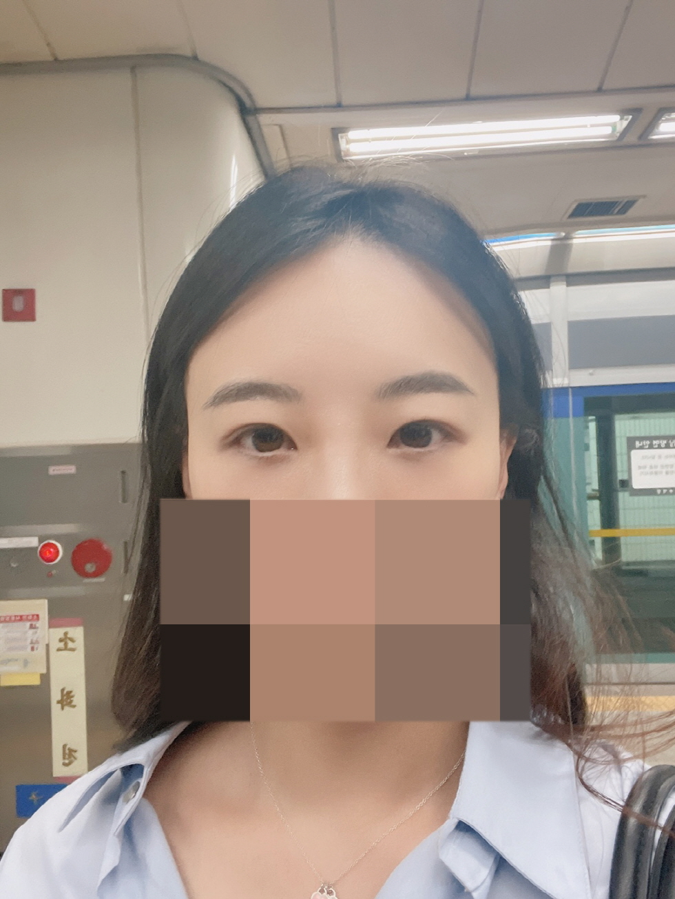 눈밑지랑 얼굴지방이식 같이 했는데 생각보다 붓기 금방 가라앉았어요~