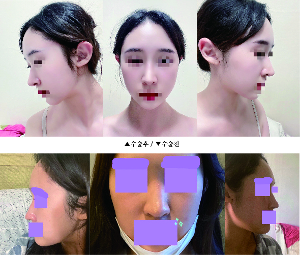 휜코, 화살코 후기남겨용!!