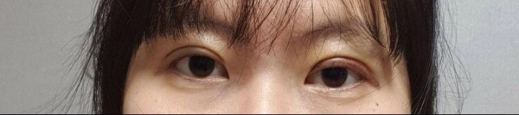 눈 재수술 후기입니다