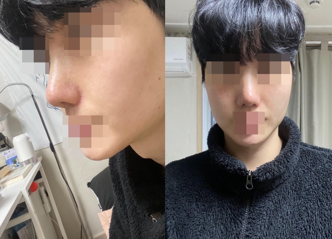 코끝 복코 수술 후기입니다