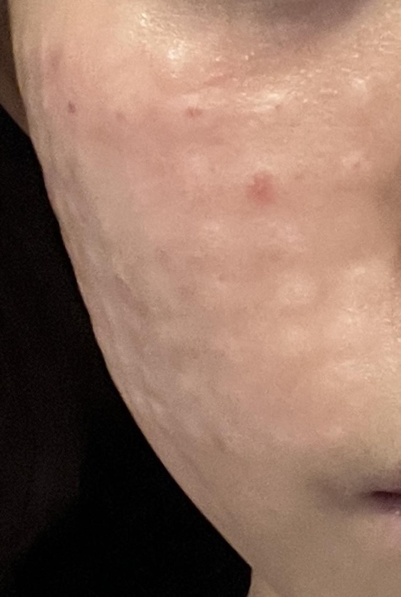리쥬란 정품 인증 라벨까지 챙겨주시고 수면으로 받아서 아프지않게 믿고 받았어요ㅎㅎ