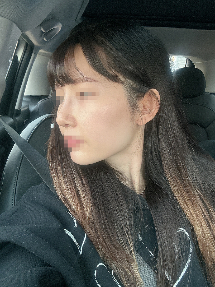 원장님 워낙 꼼꼼하신분이라 콧구멍 비대칭?도 전혀 없고 잘 회복했습니다!!