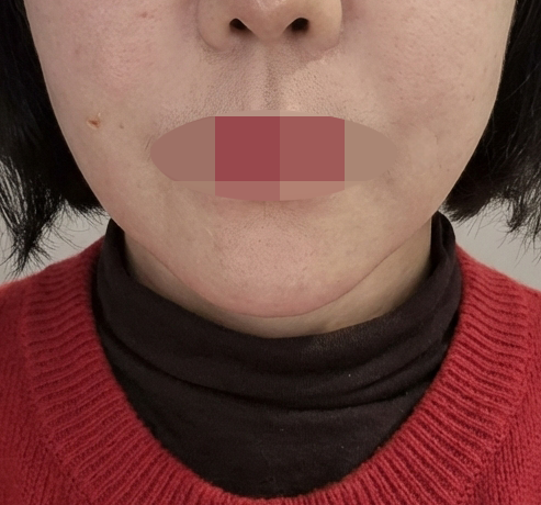 팔자주름 때문에 쥬베룩 볼륨 받았는데 자연스럽게 채워져서 만족이에요 ㅎㅎ