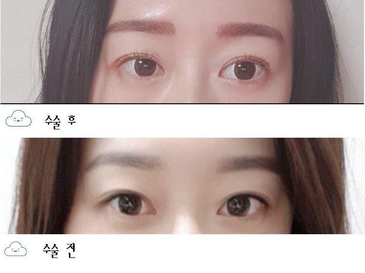 쌍꺼풀 + 눈매교정 후기입니당