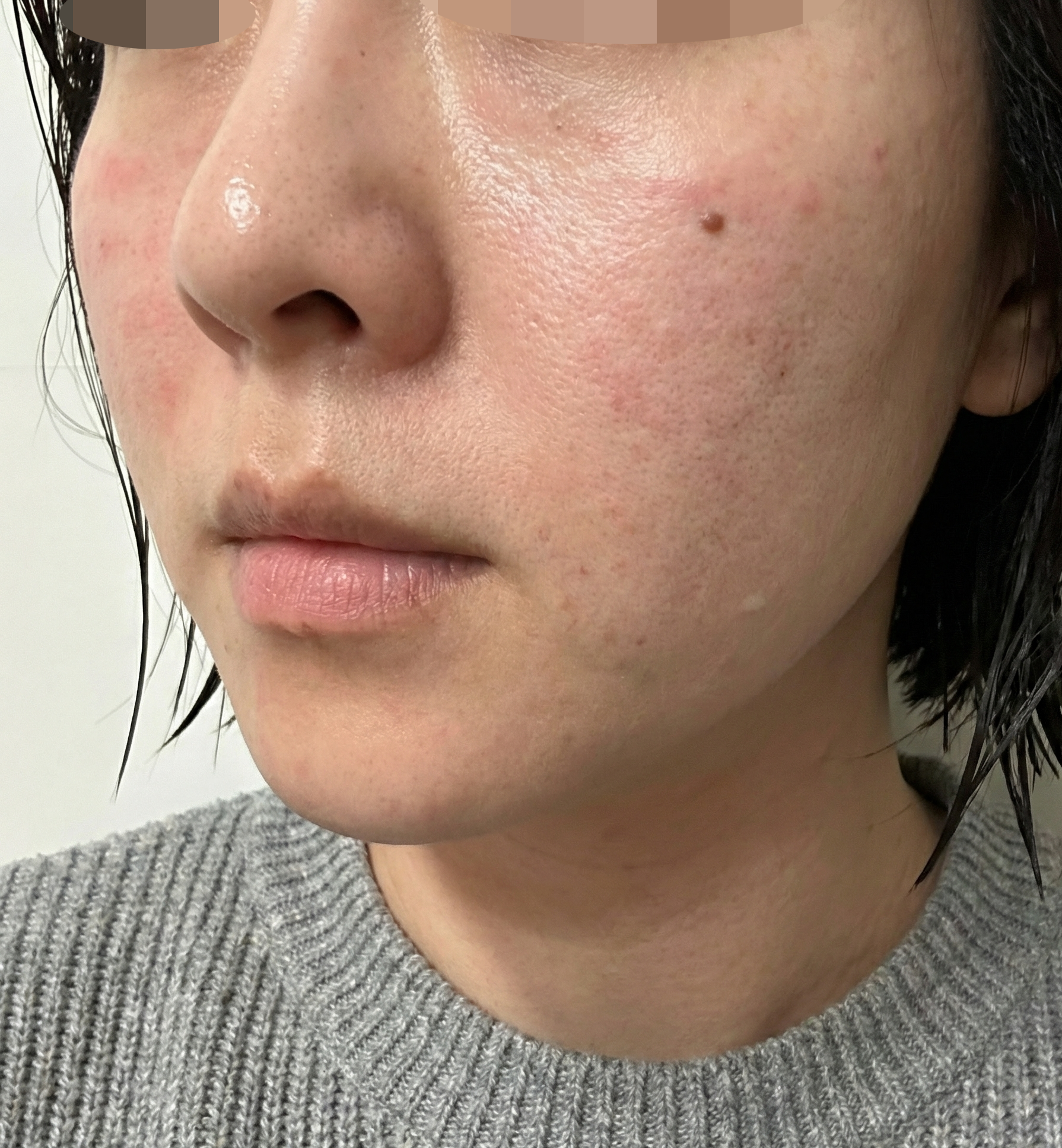 피부장벽 무너졌을 때 엑소좀! 트러블 완화에 딱이에요!
